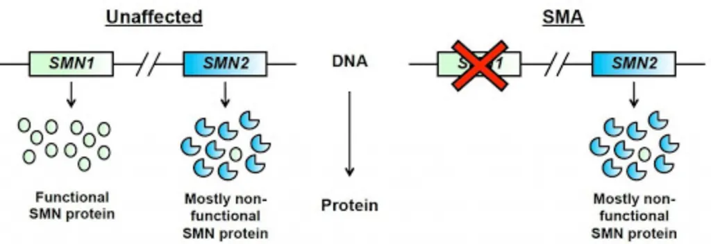 Diagram showing how SMN1 makes full-length SMN protein while SMN2 makes mostly incomplete protein